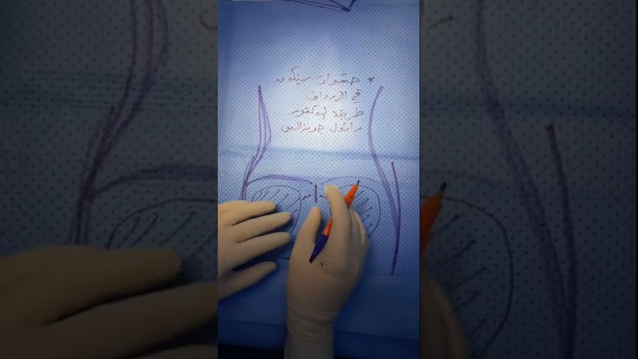 تكبير الارداف باستخدام حشوات السيلكون (تقنية الدكتور غونزاليس)