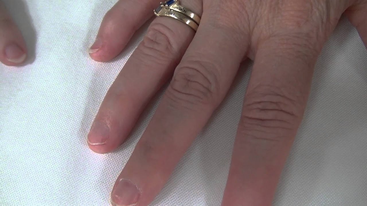 Hands, arms, knees and feet of people with Nail patella syndrome
