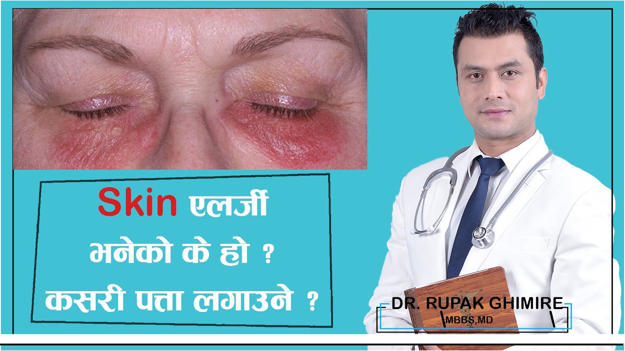 Skin एलर्जी भनेको के हो ? ||   कसरी पत्ता लगाउने ? || Dr. Rupak Ghimire