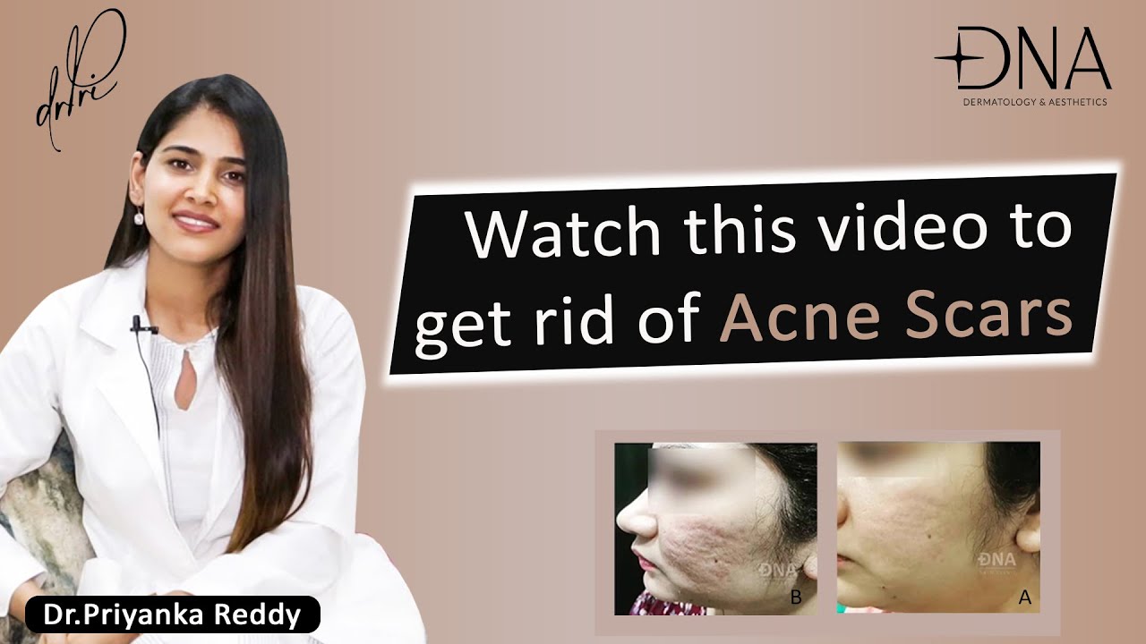 How to Treat Acne Scars? | Best Solution to Post Inflammatory Hyperpigmentation | Dr. Priyanka Reddy