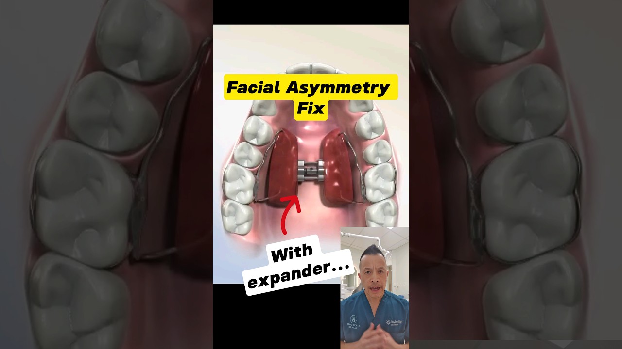 Fixing Facial Asymmetry with a Palate Expander: Here's How! #dentallan #dentist #shorts