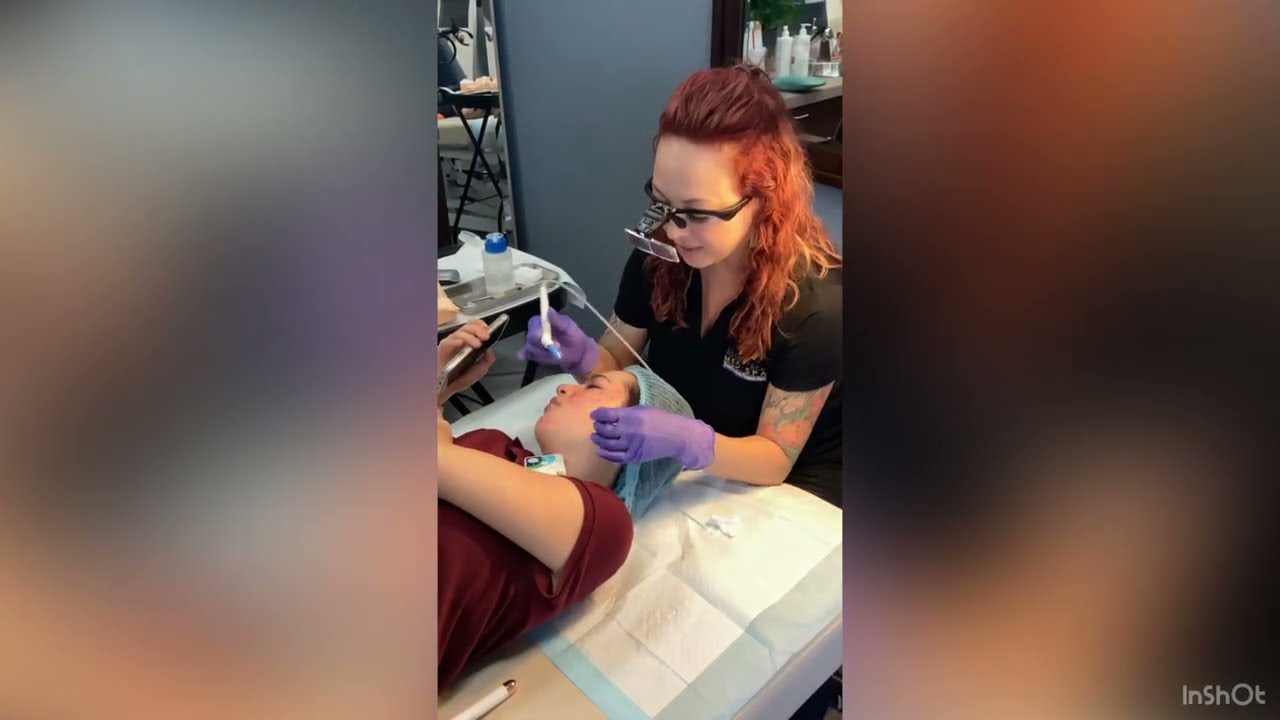 Acne Treatment at About Face Med Spa - Agnes RF Microneedling