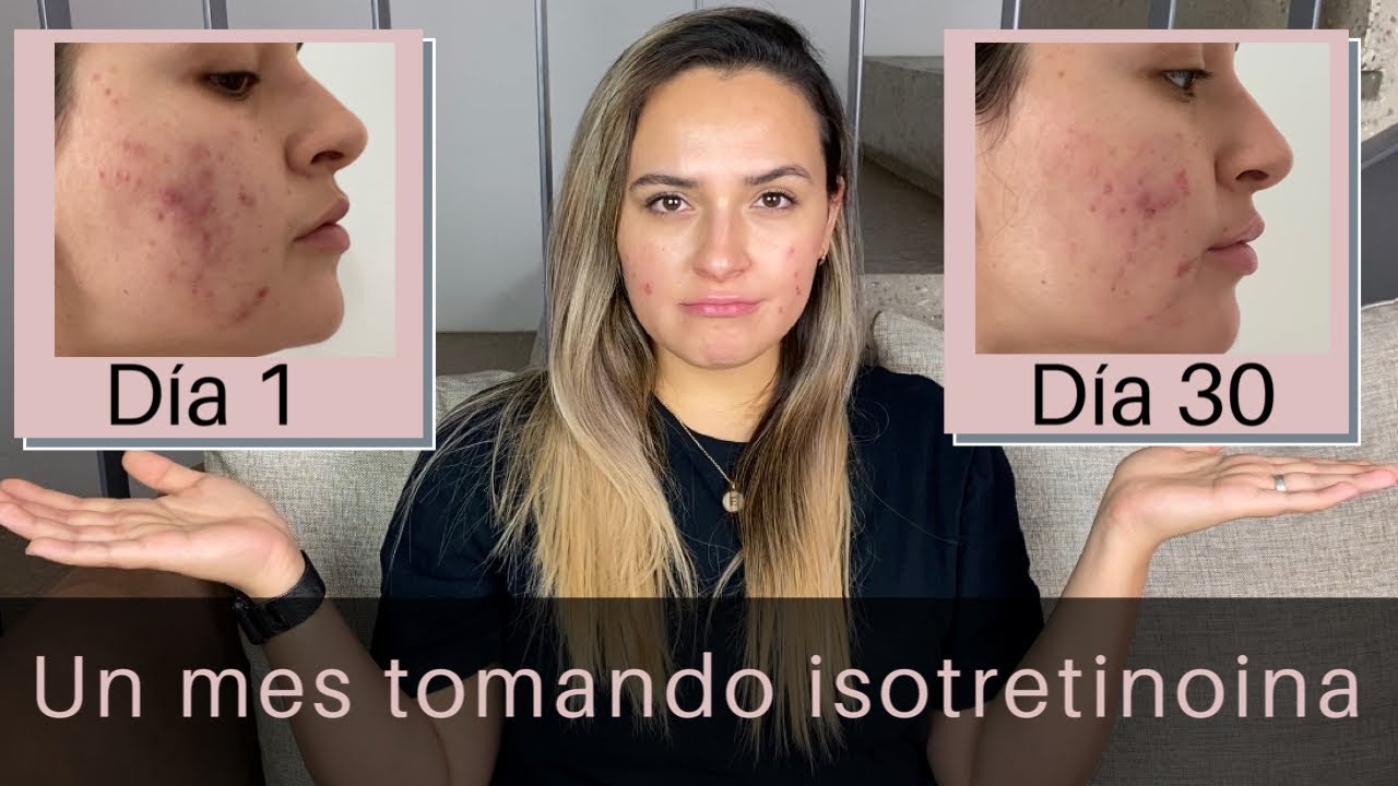 Primer mes tomando isotretinoina! | mi historia con el acné | isotretinoina