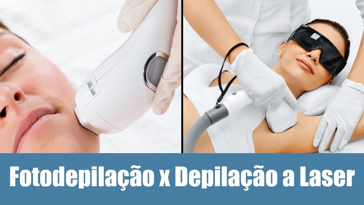 Fotodepilação x Depilação à laser - Qual é a melhor opção?