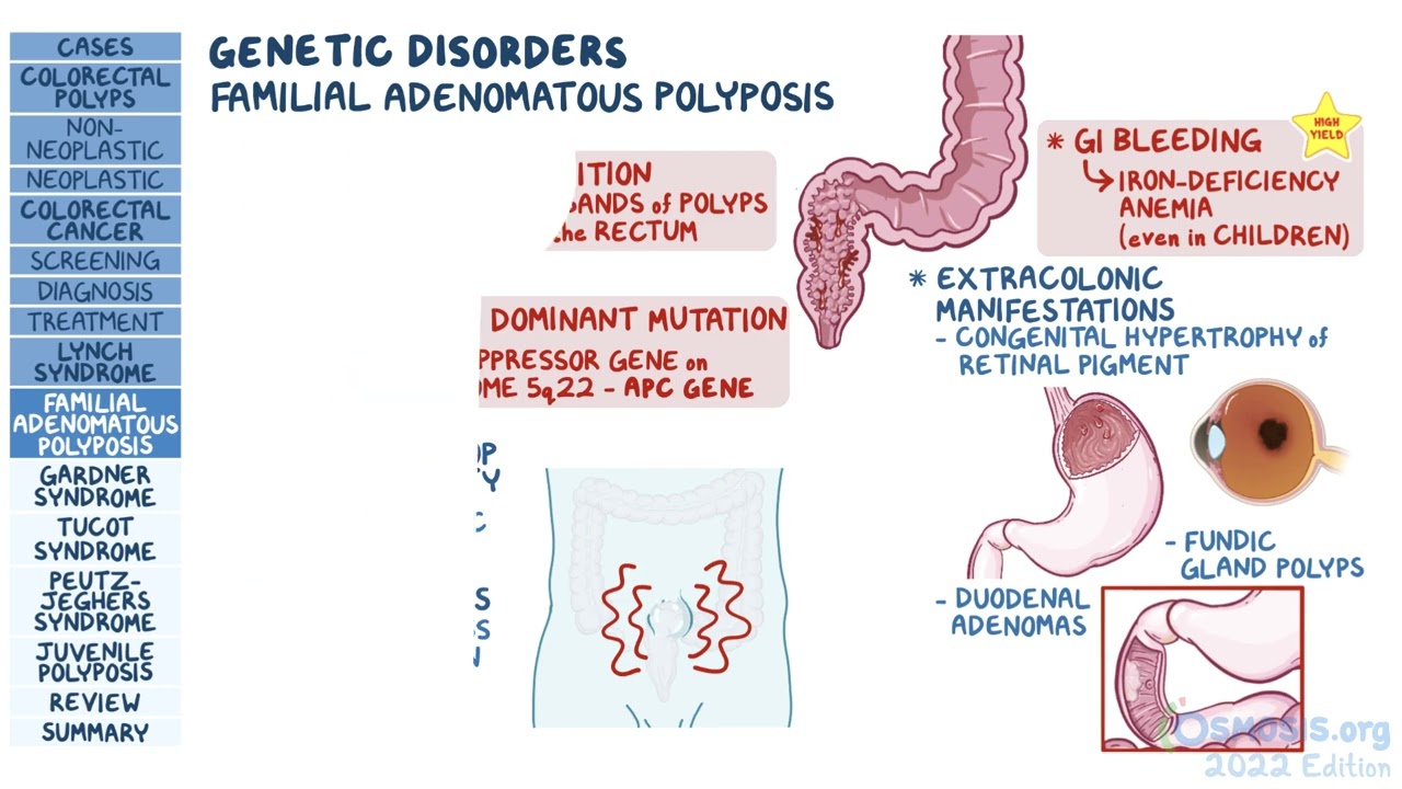 Colorectal Polyps & Cancer | GI Surgery | Osmosis Pathology Review