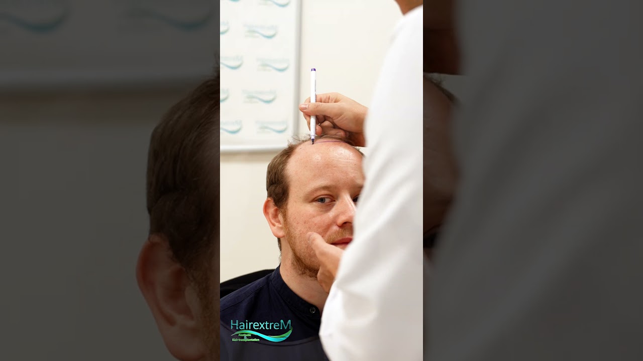 HairextreM | hair transplant Journey  !  