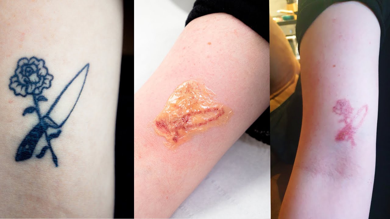 Laser Tattoo Removal: Procedure Steps