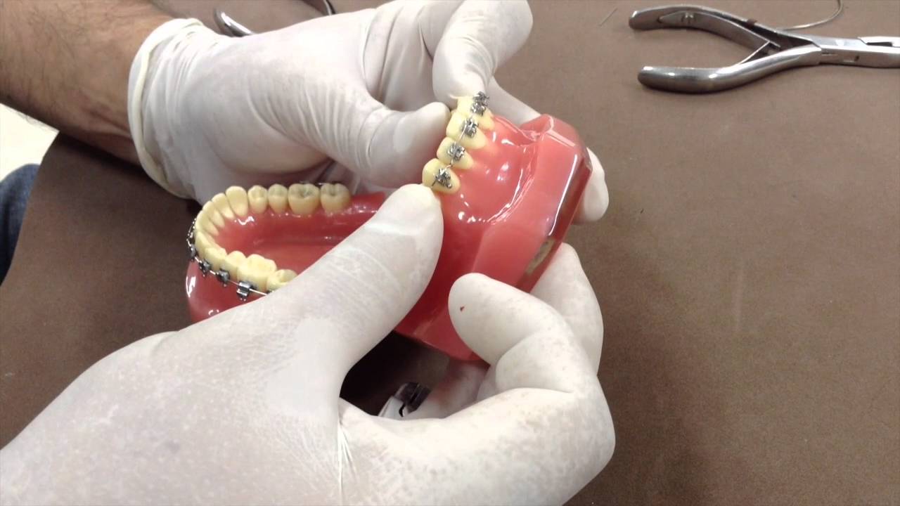 Torques em Ortodontia - Dr. Pedro Andrade Jr