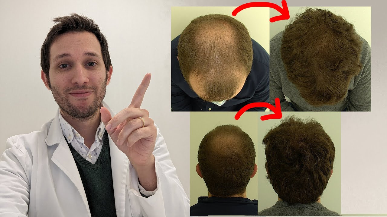 Recuperación milagrosa de pelo sin injerto