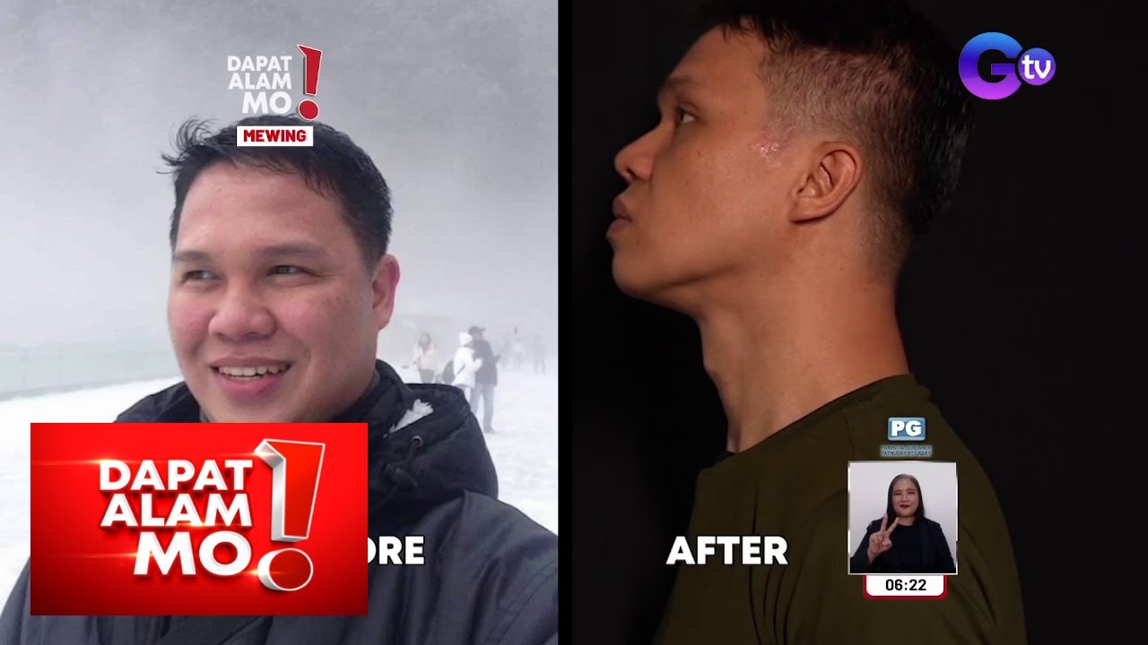 ‘Mewing’, sagot sa pangong ilong at double chin? | Dapat Alam Mo!