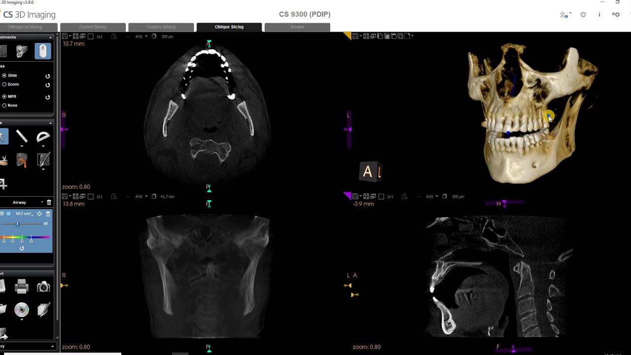 CS Airway Overview and Manually Visualizing Airway