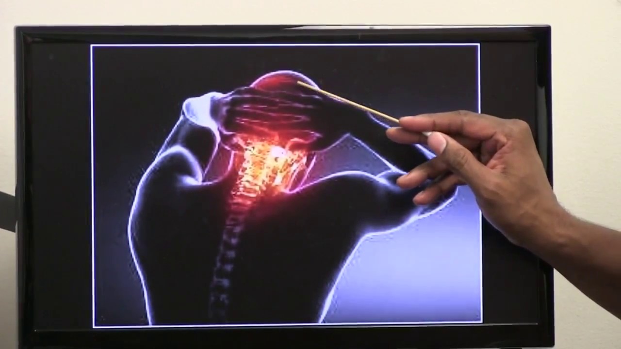 Occipital neuralgia : Symptoms & Treatments so EVERYBODY Understands!