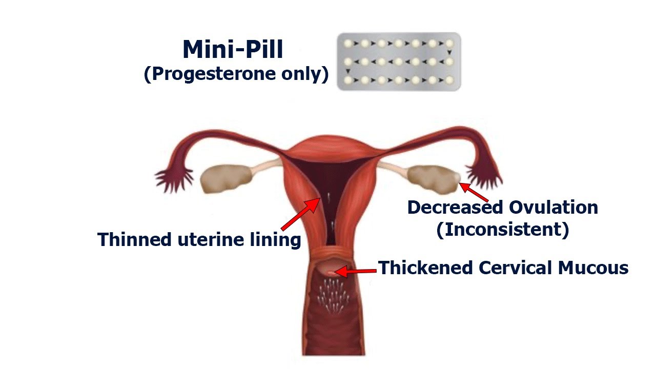 Mini Pill (Progesterone Only)