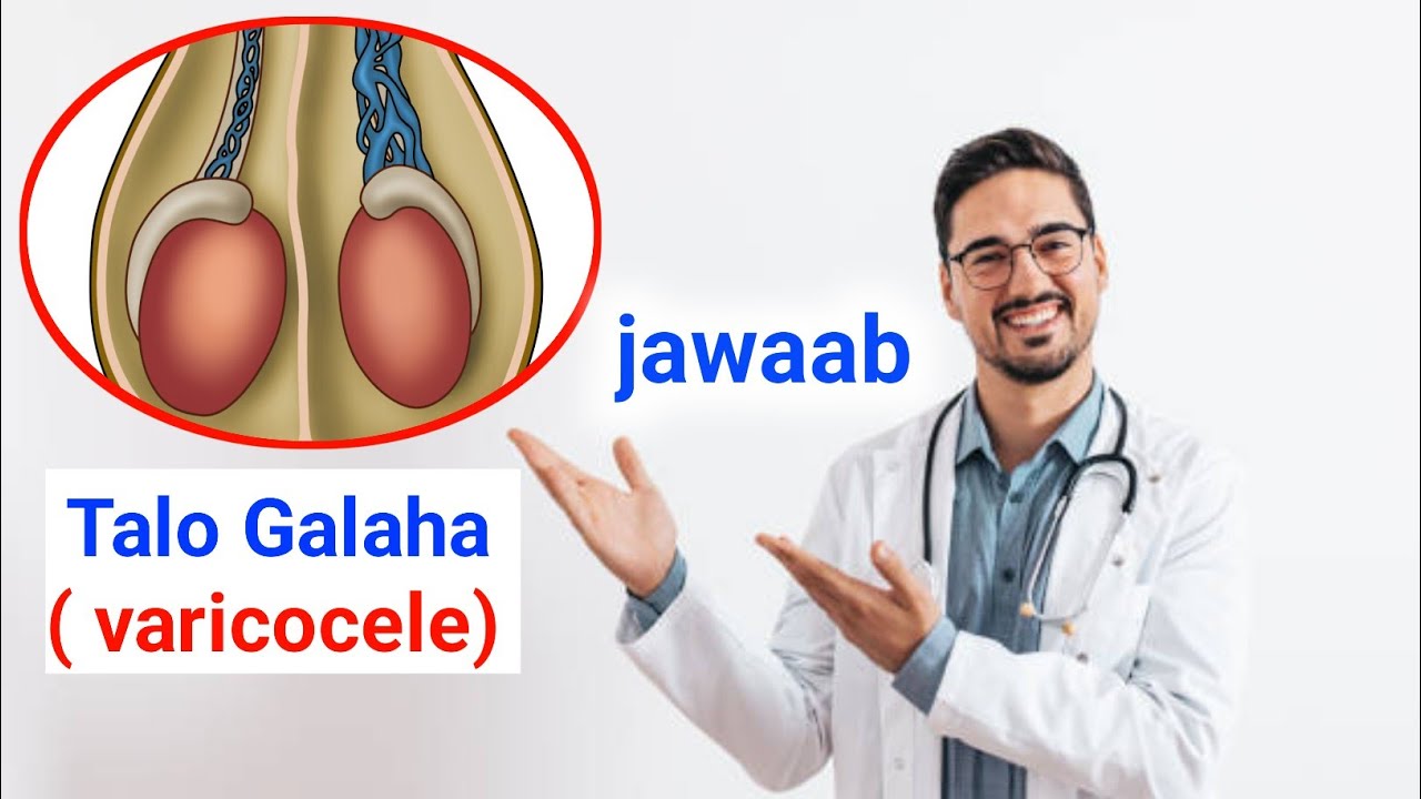 Xauunka Galaha ( varicocele ) maxaa lagaa qariyay oodaan ogeeyn ??