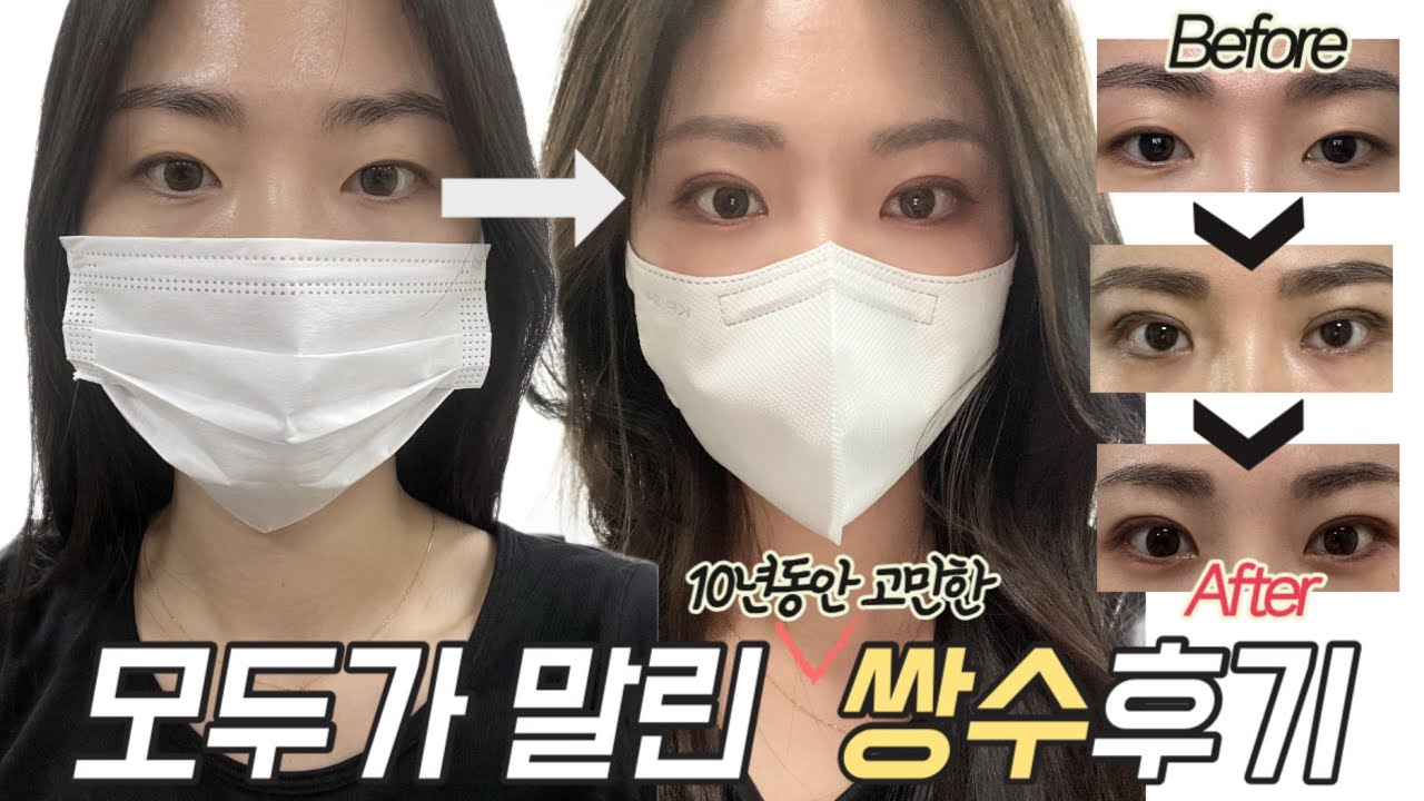 쌍수 후기, 자연유착 매몰쌍수, 쌍수 브이로그, 쌍수부기관리, 쌍수부작용, 쌍수 상담후기(쌍수상담체크리스트공유) 쌍수 일주일, 쌍수 한달 후기
