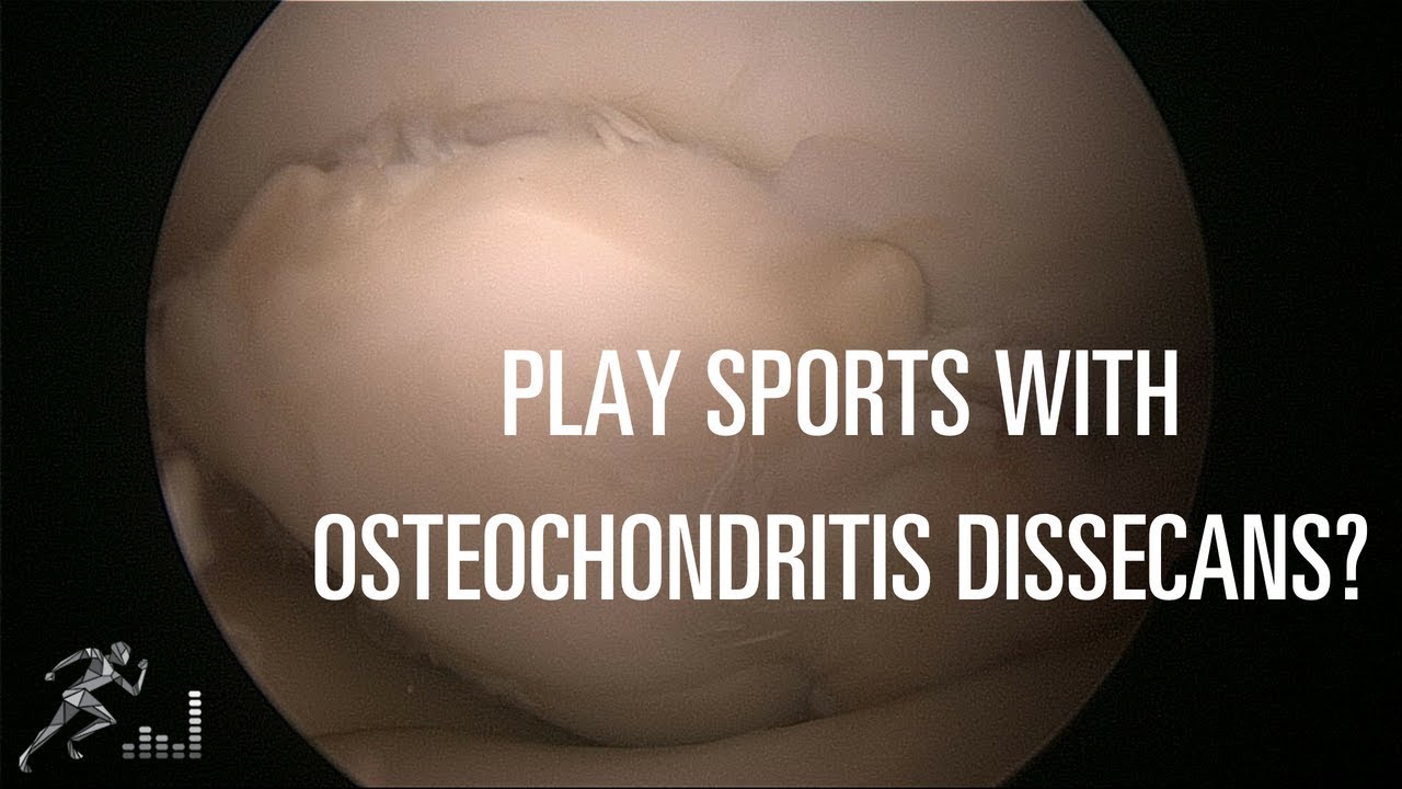 Should you play sports with an OCD lesion in your knee?