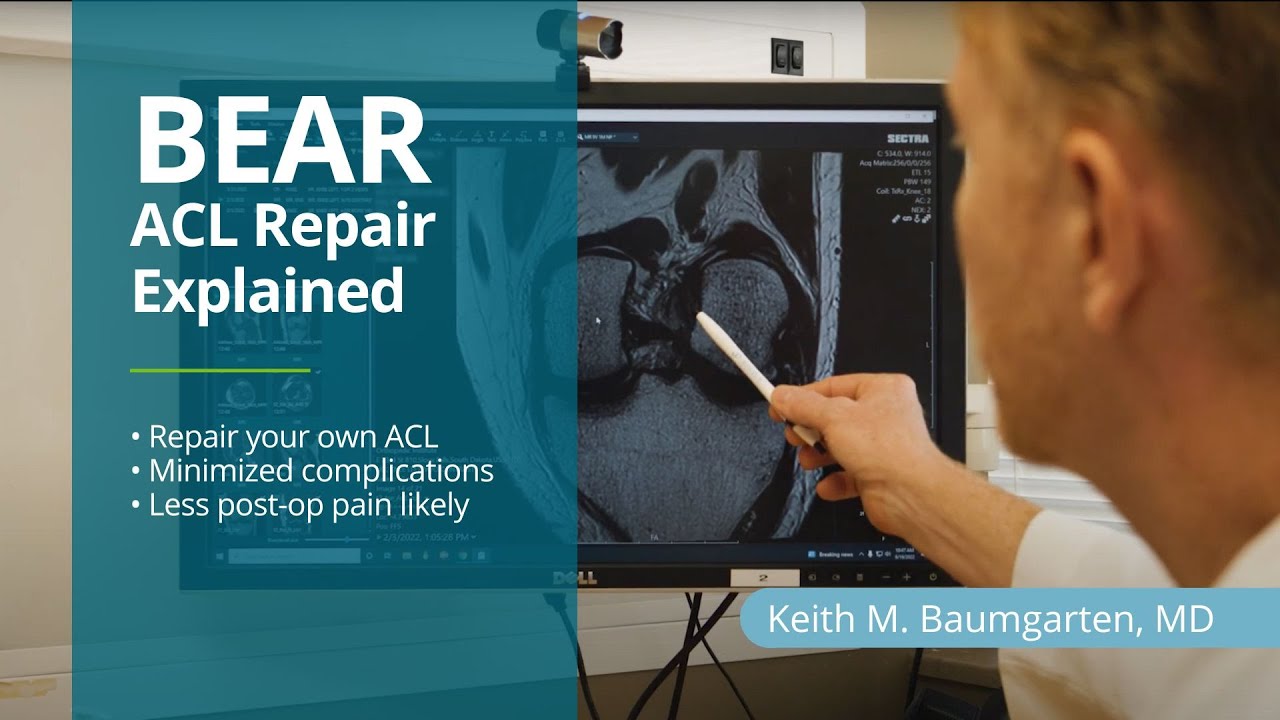 BEAR ACL Repair Explained by Orthopedic Surgeon Keith Baumgarten, MD.