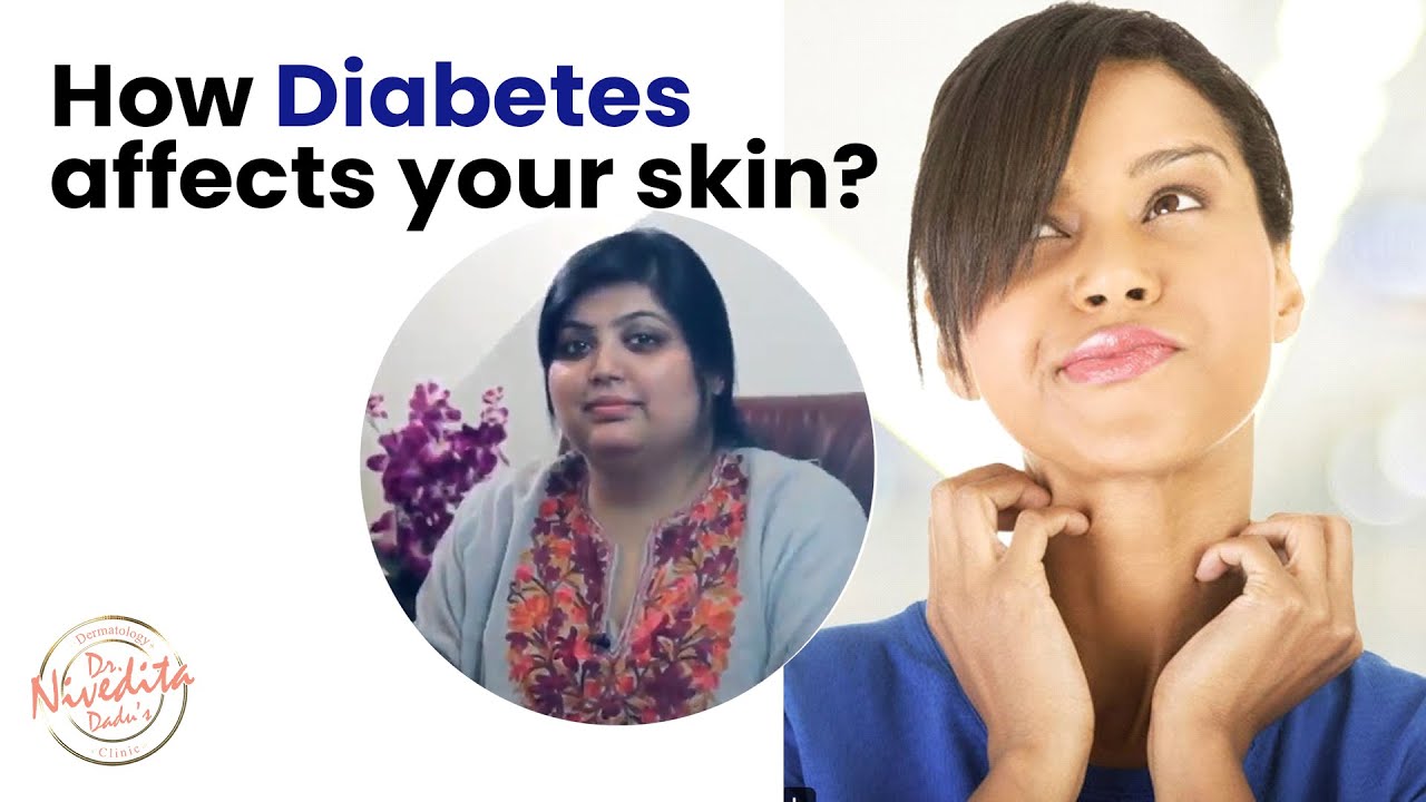 शुगर के कारण होने वाली त्वचा की समस्याएं | Skin Problems caused by Diabetes Dr. Nivedita Dadu's