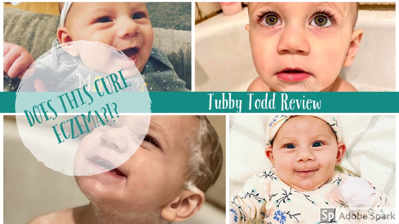 HOW I FIXED MY KIDS ECZEMA //TUBBY TODDY REVIEW