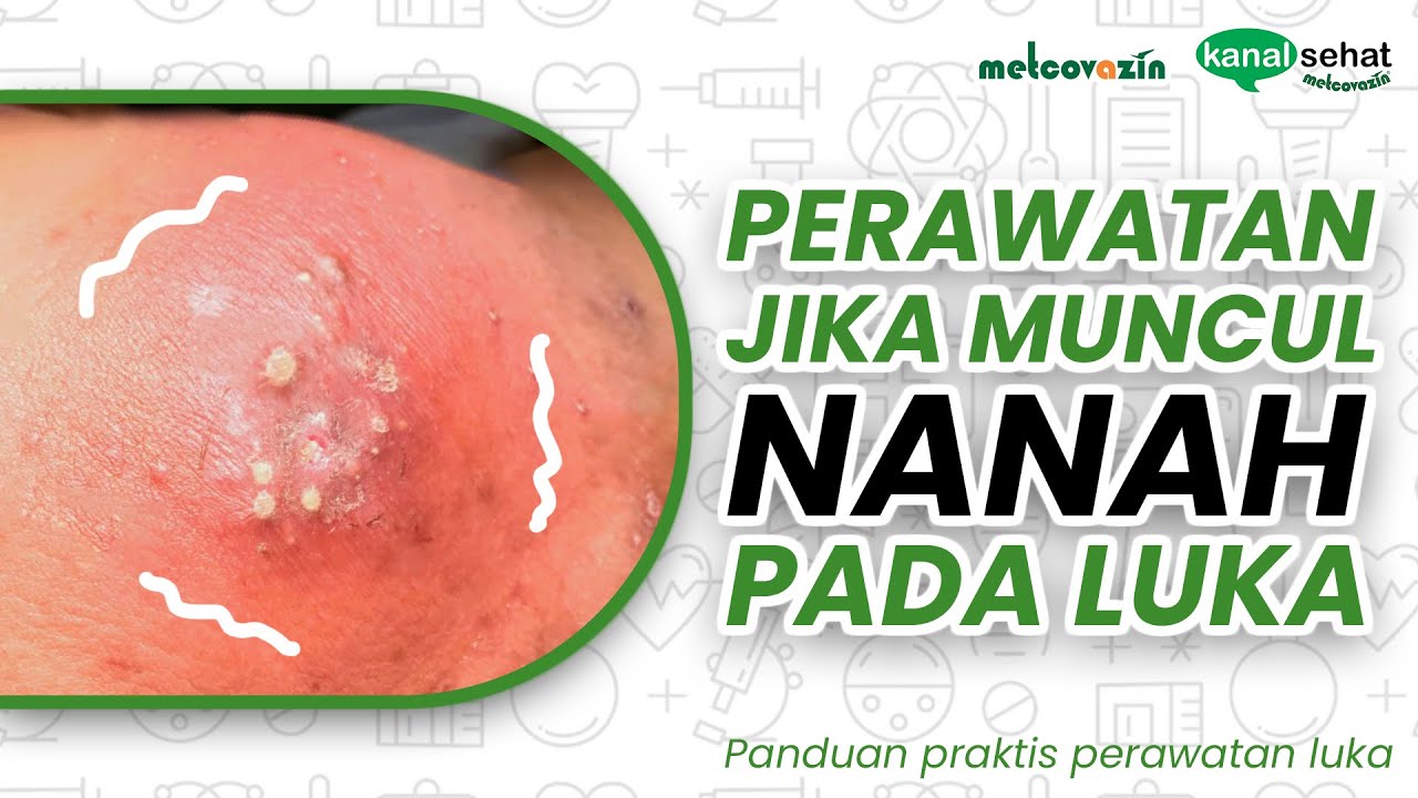 Perawatan Jika Muncul Nanah Pada Luka | Kanal Sehat Metcovazin