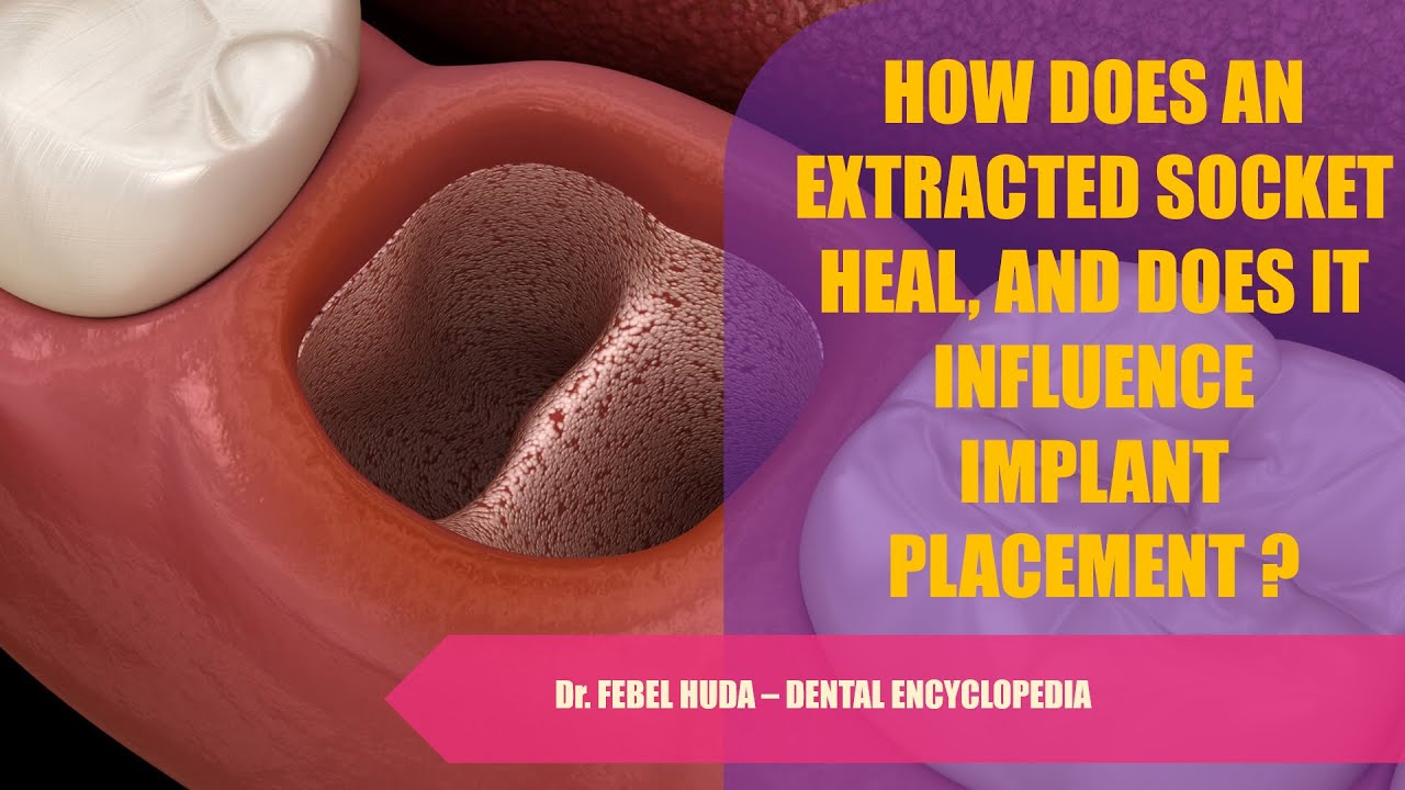 HOW DOES AN EXTRACTED SOCKET HEAL, & DOES IT INFLUENCE IMPLANT PLACEMENT?