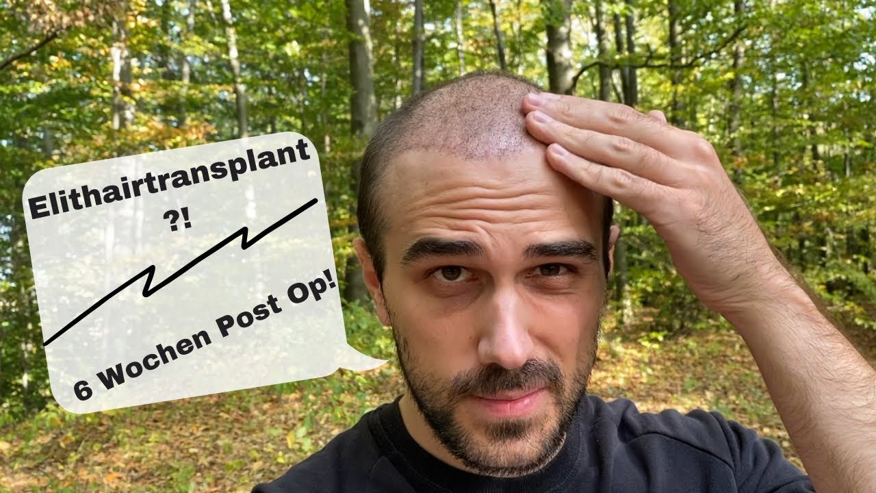 Ehrliche Meinung zu Elithairtransplant & 6 Wochen Post Op 🔝