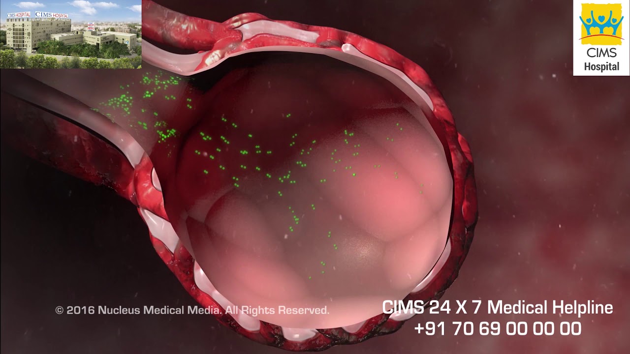 Pneumonia (Hindi) - CIMS Hospital