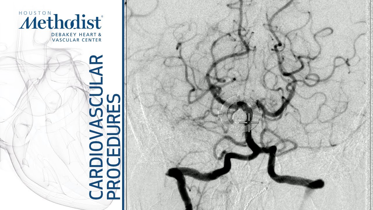 Cerebral Angiogram via Trans Radial Approach (A. Lumsden, MD, O. Diaz, MD, S. Montelongo, DO)