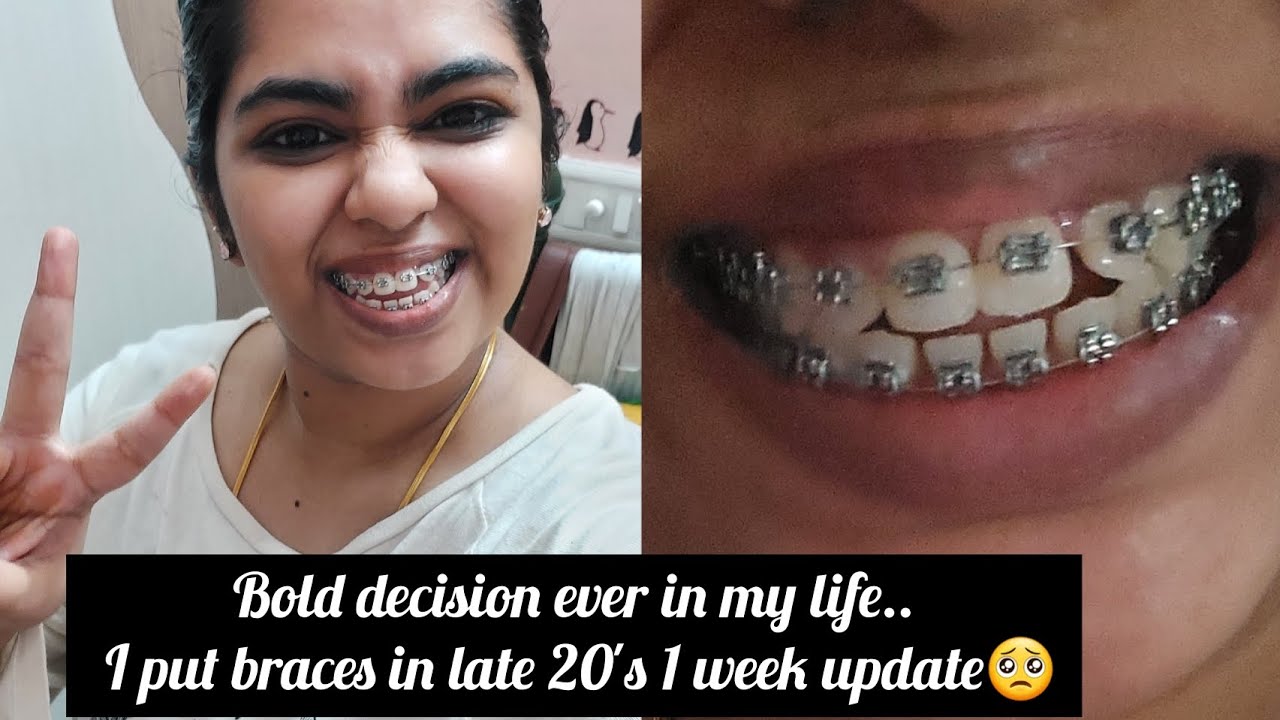 one week braces update 🥺🥺was it painful?? sideeffects😭