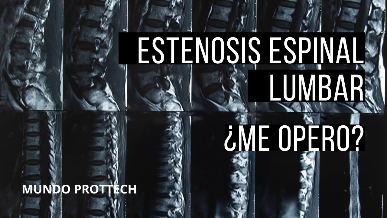 Estenosis espinal lumbar: ¿debería operarme? #estenosisespinal