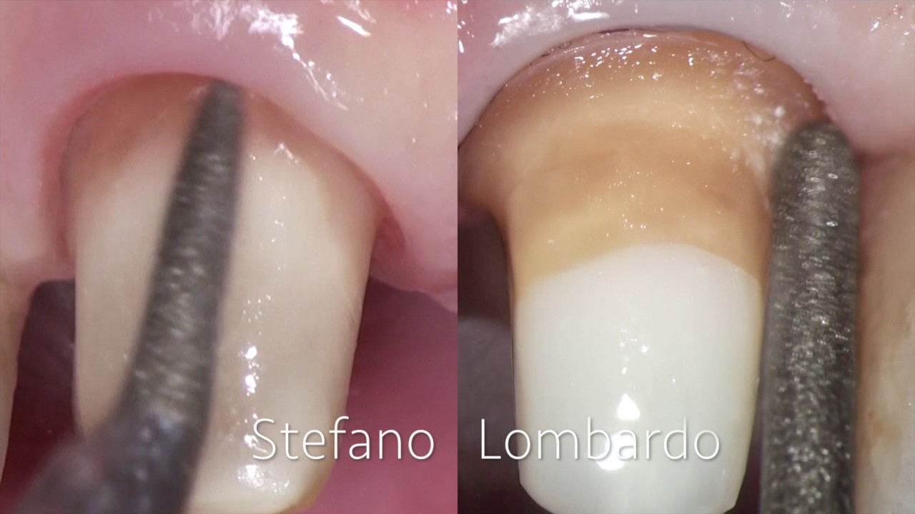BOPT feather edge vs Chamfer