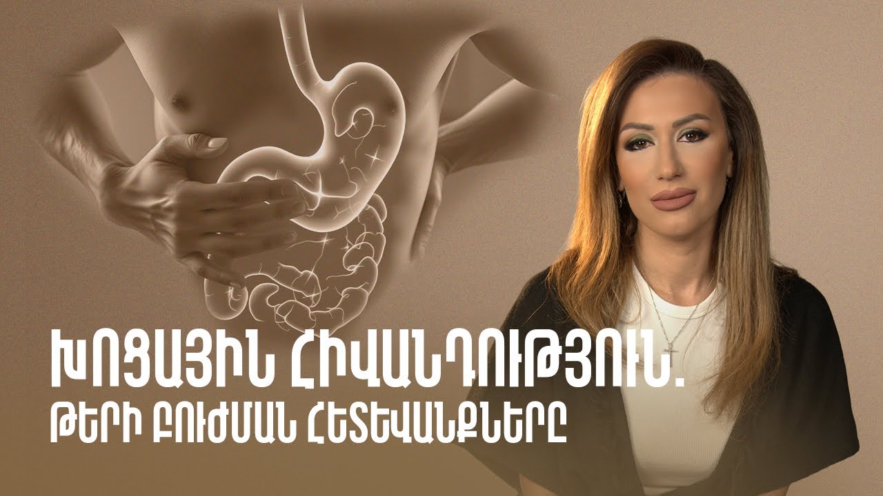 Խոցային հիվանդություն. թերի բուժման հետևանքները | Gastro Time 66