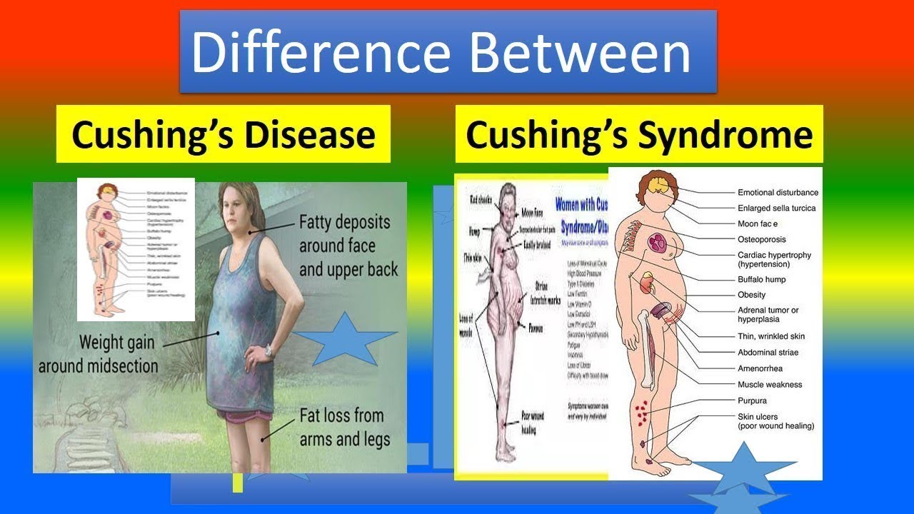 Cushing Syndrome VS Cushing Disease| Long Case | Medical Lecture