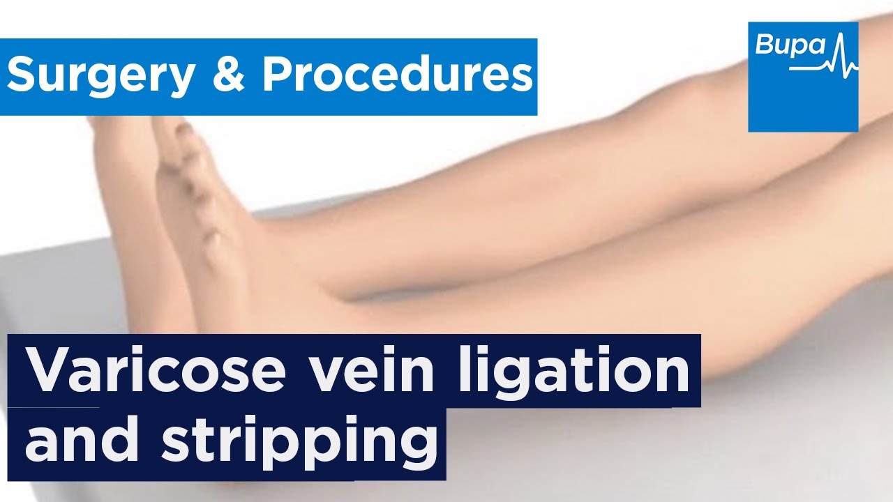 How varicose vein ligation and stripping is carried out | Bupa Health