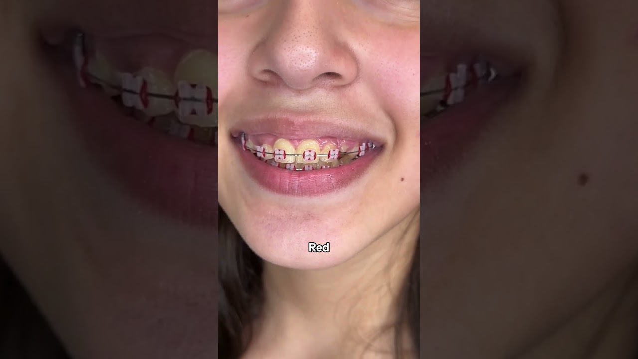 Braces Colors Before and after 8 weeks