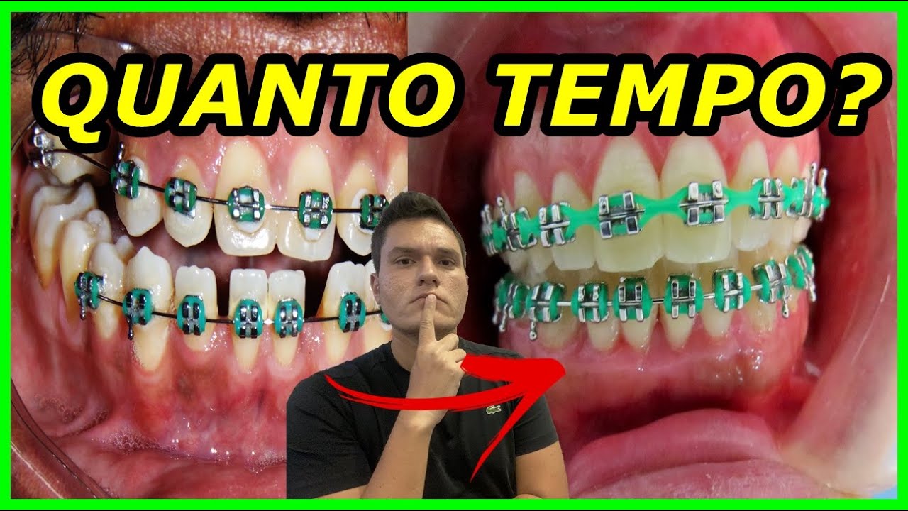 QUANTO TEMPO O ELÁSTICO EM CORRENTE LEVA PARA FECHAR ESPAÇOS DE DENTES SEPARADOS?