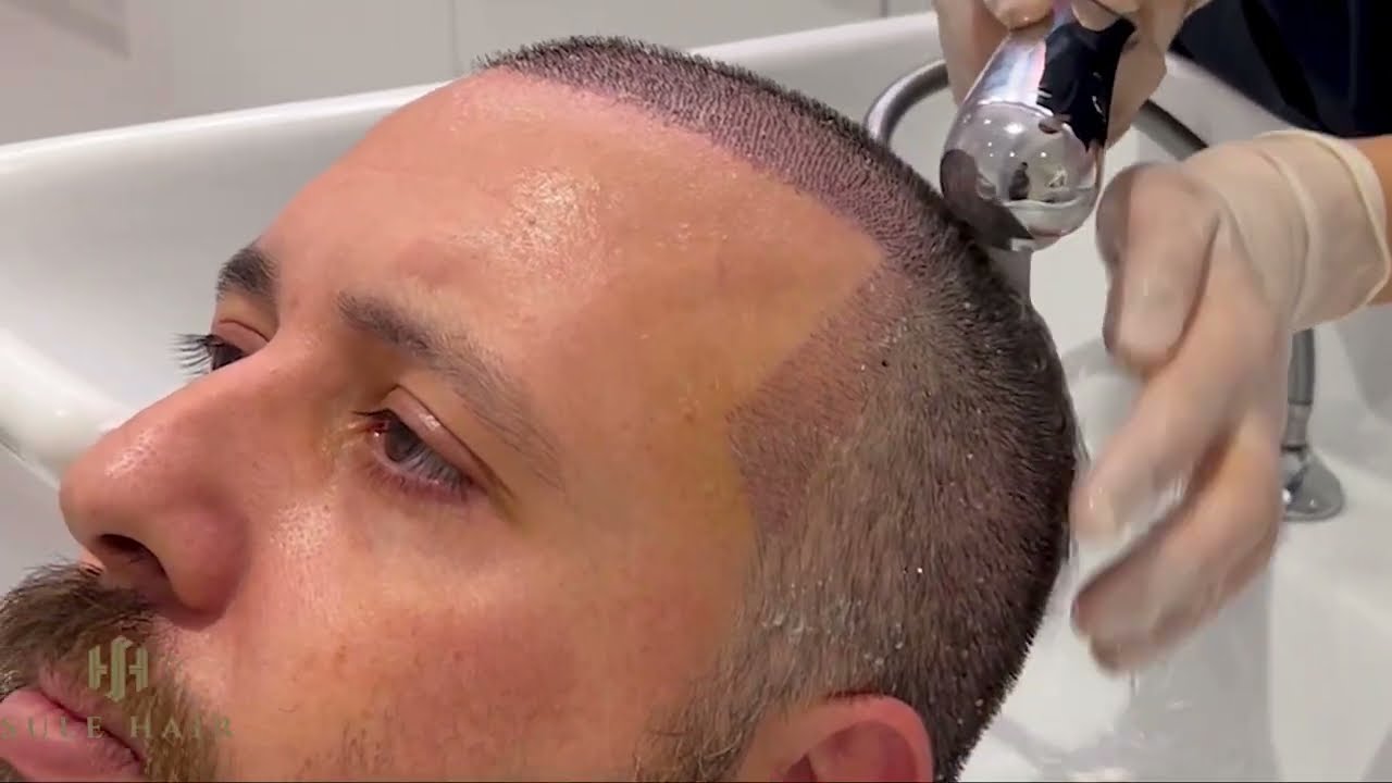 Scab Removal Phase After Hair Transplant - SULE HAIR TRANSPLANT