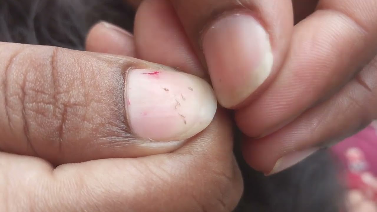 Nitpicking ASMR video 250      ULTRA ZOOM-IN #kuto #piolho #nitpicking #asmr #petantumo