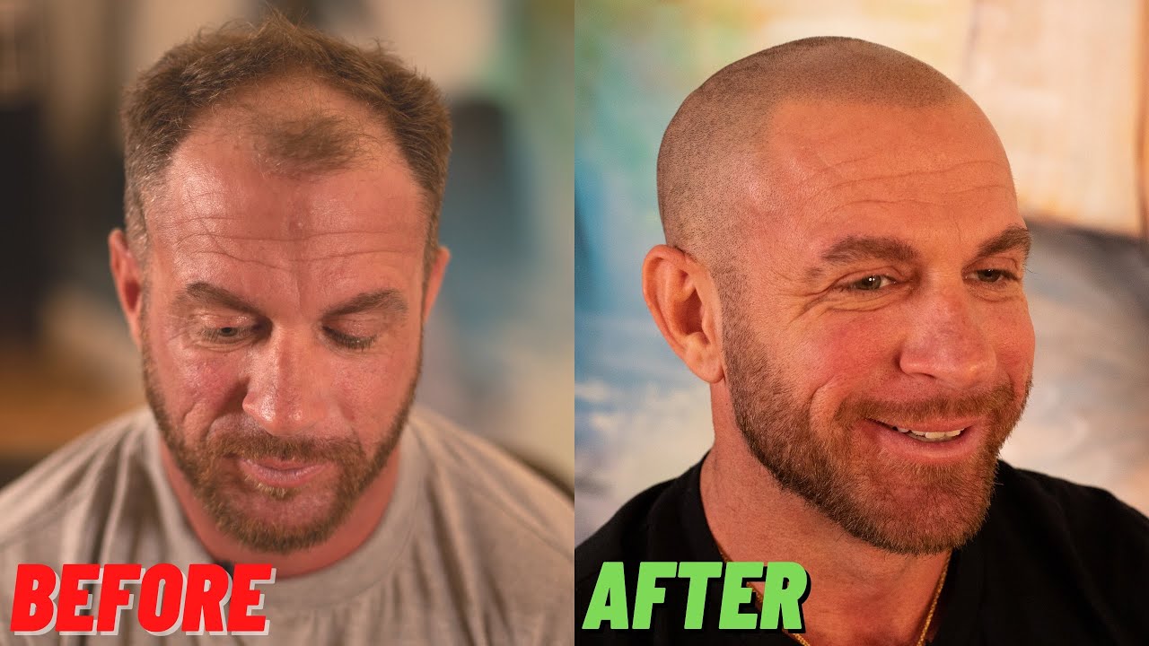 AMAZING RACE Star gets SCALP MICROPIGMENTATION
