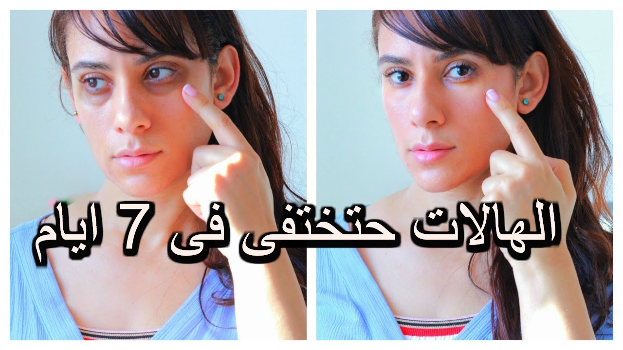 5 طرق للتخلص سريعا من الهالات السوداء  طبيعياHow to remove dark circles under eyes permanently I