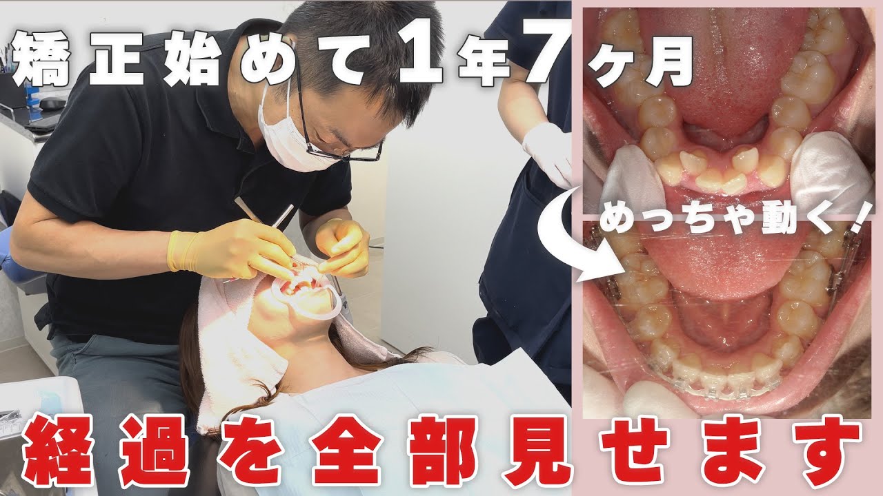 【矯正の経過】表ワイヤーで1年7ヶ月の矯正を全部見せます【出っ歯改善】