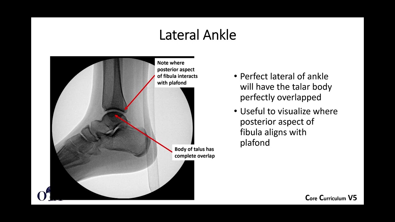 Ankle fractures - 1 of 4 - OTA CCv5