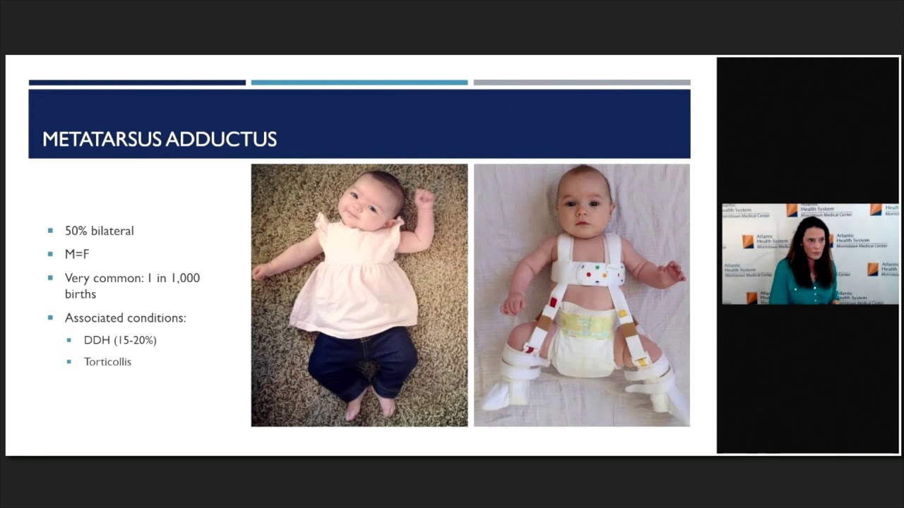 What’s In and What’s Out…Toeing-Rotational Alignment in Children | Ellen Dean-Davis, MD