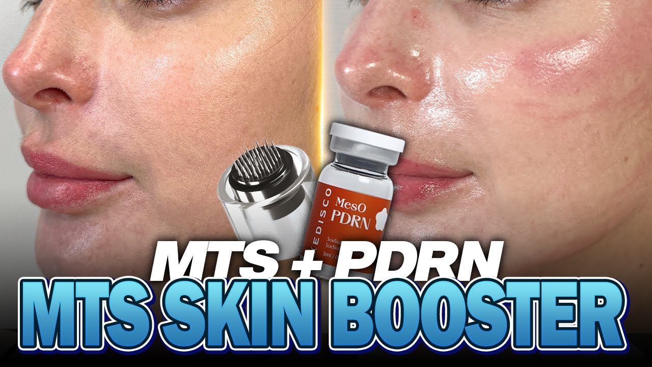 MTS + PDRN = Glass Skin! Watch the FULL Process & Results! 💖 #microneedling #mts