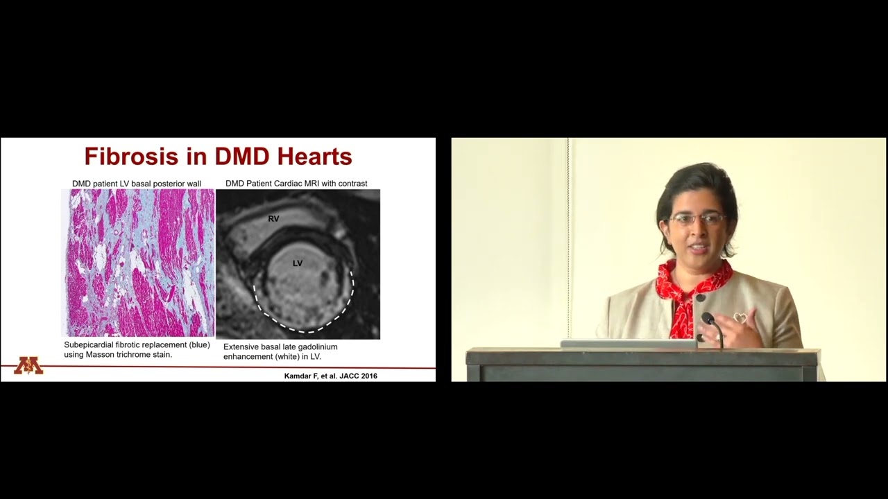 Cardiomyopathy in Adults with DMD-BMD
