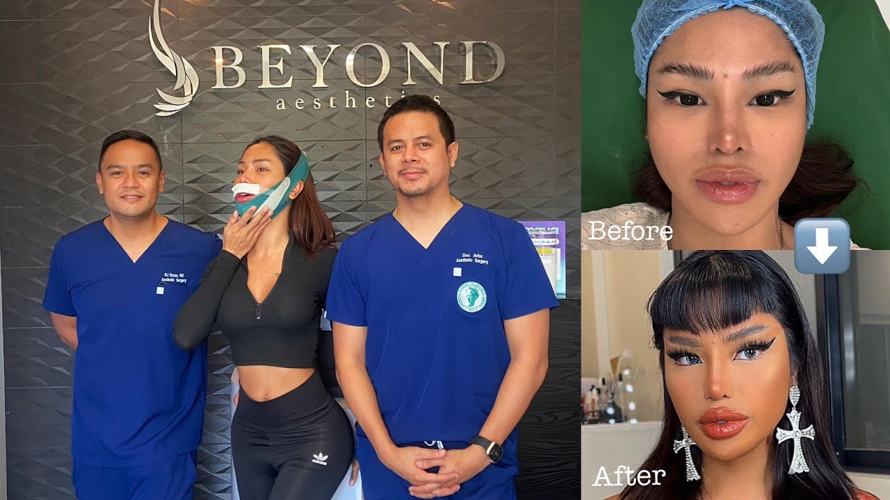 FACE FEMINIZATION Journey with Beyond Aesthetics Clinic