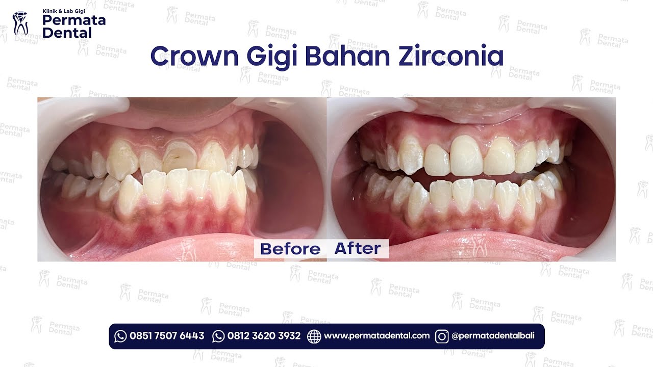 Transformasi Gigi Depan Tidak Rata Jadi Lebih Sejajar | Crown Gigi Zirconia di Permata Dental