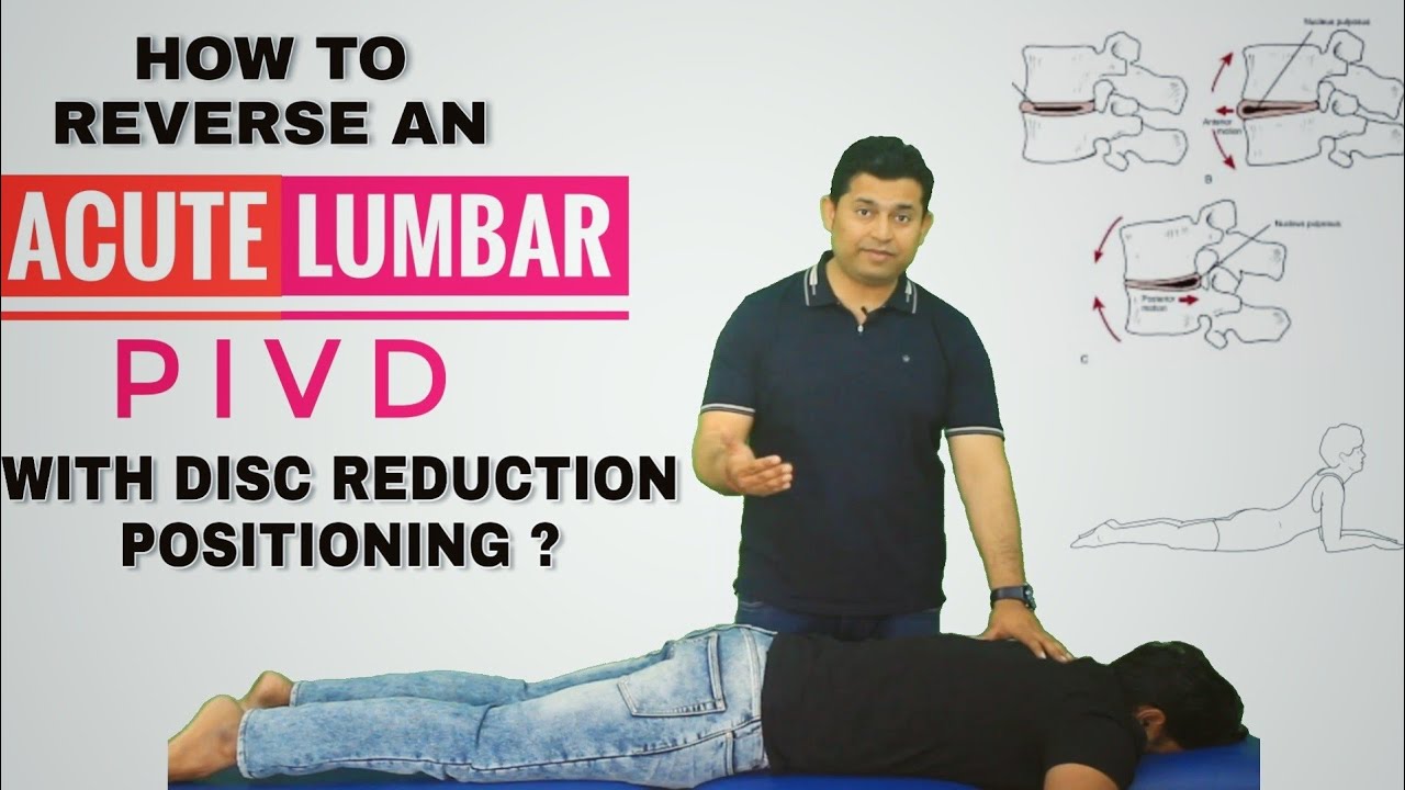 SELF TREATMENT OF ACUTE LUMBAR DISC PROLAPSE (Sciatica) USING DISC REDUCTION POSITIONING