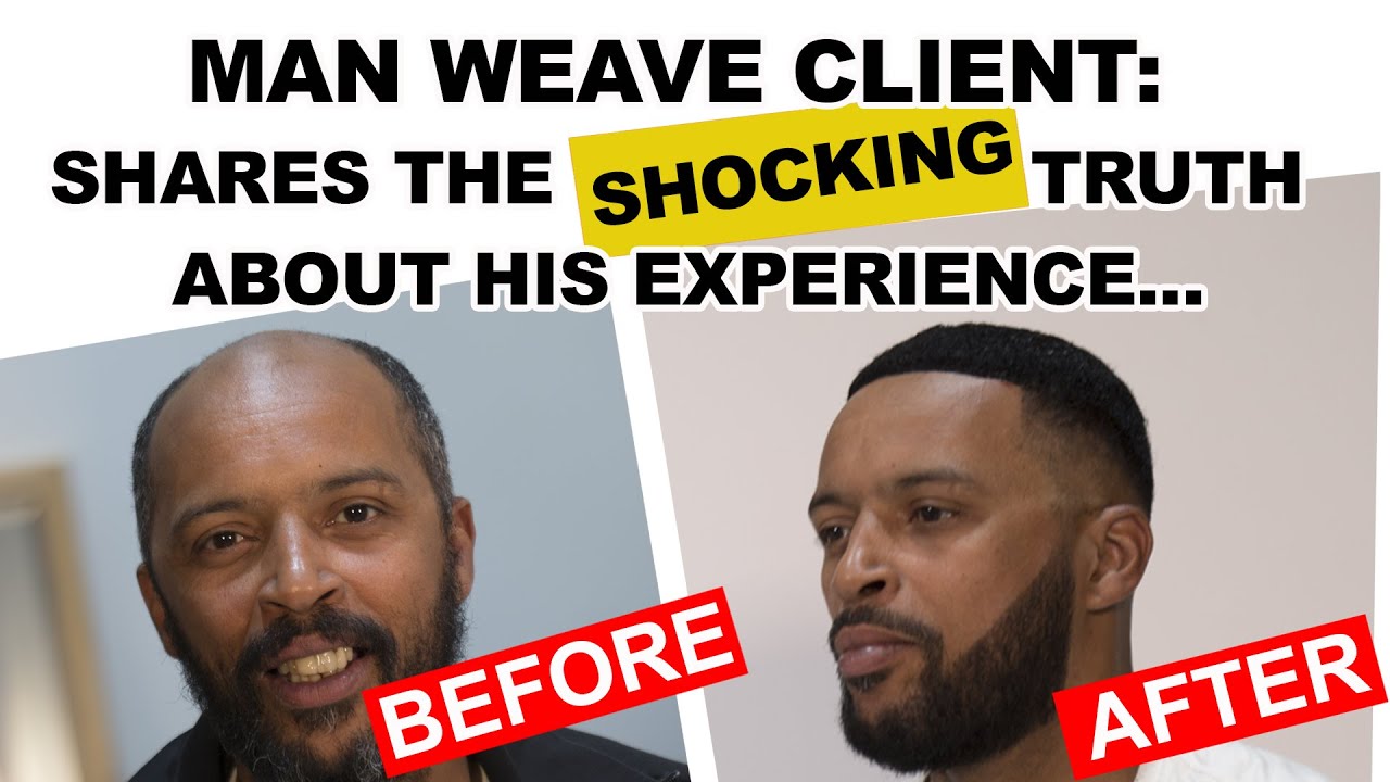 Hair Replacement Client: Shares The Shocking Truth About His Experience!!!
