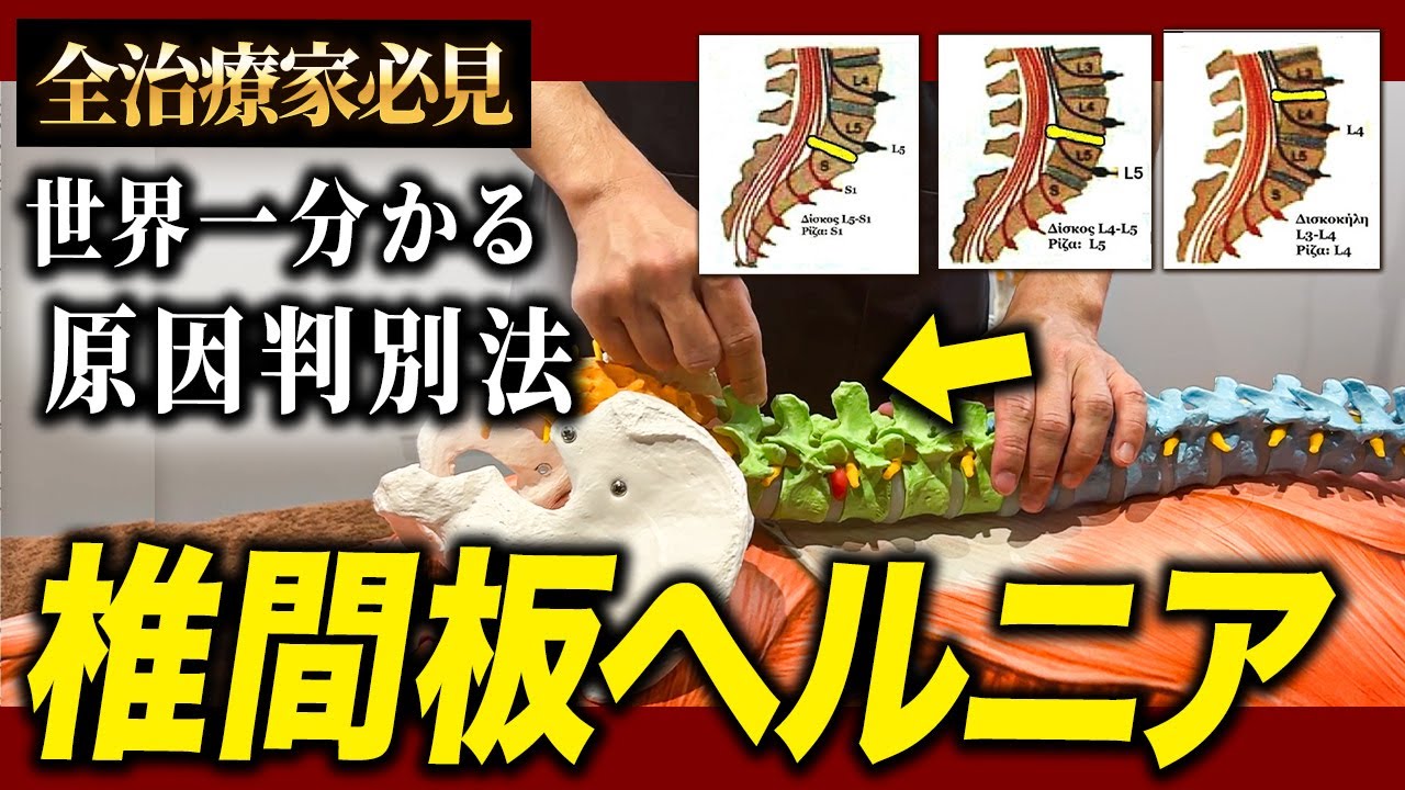 【永久保存版】ヘルニアの判別方法と治療テクニック｜L4/L5/S1の神経学的所見を徹底解説します！